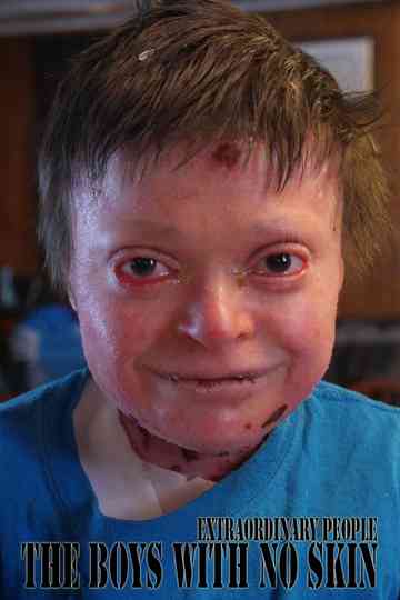 Extraordinary People: The Boys With No Skin Poster